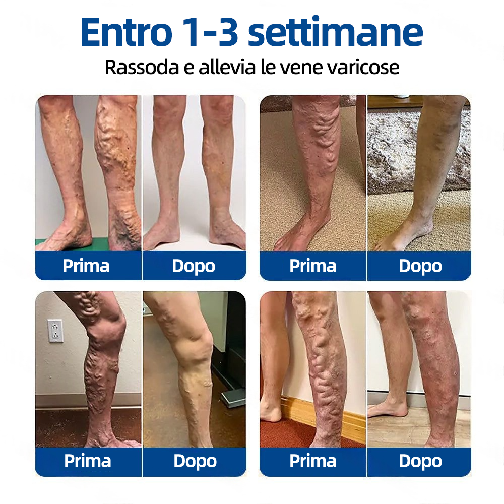 Healrize® VeinTarget Patch Microneedle  Sollievo Immediato, Risultati a Lungo Termine🏃‍♂️‍➡️🏃‍♂️‍➡️2
