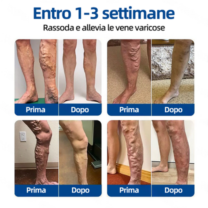 Healrize® VeinTarget Patch Microneedle  Sollievo Immediato, Risultati a Lungo Termine🏃‍♂️‍➡️🏃‍♂️‍➡️2